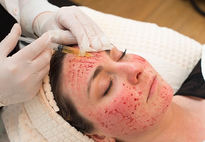 Vampire facial PRP treatment