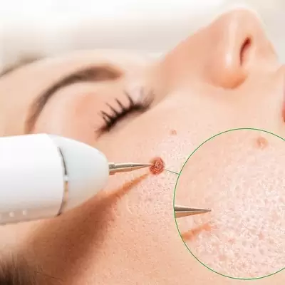 CO2 fractional laser wart and mole removal
